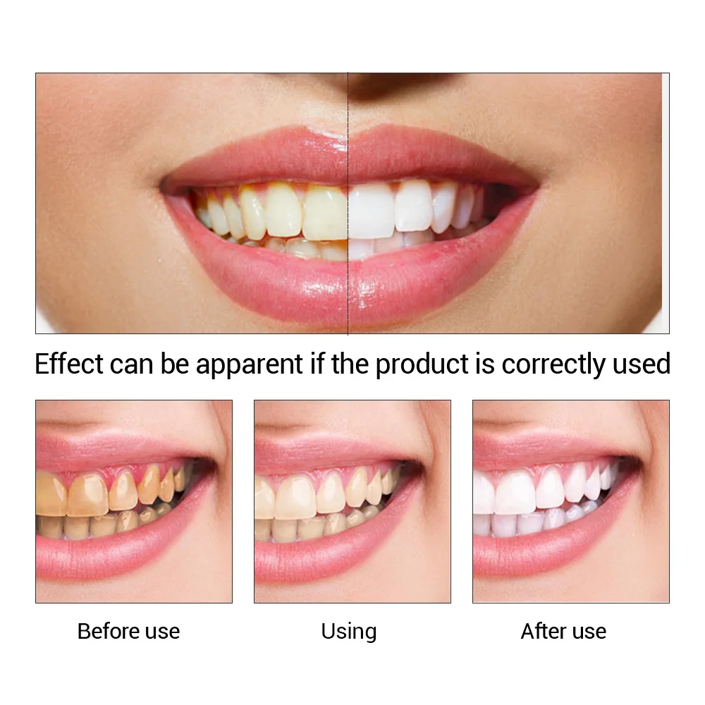 FTEENPLY Teeth Whitening Essen - Teeth Whitening Results recension och pris