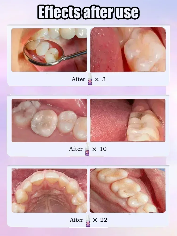 Tooth decay Repair Repairing C - Teeth Whitening Charcoal Powder recension och pris