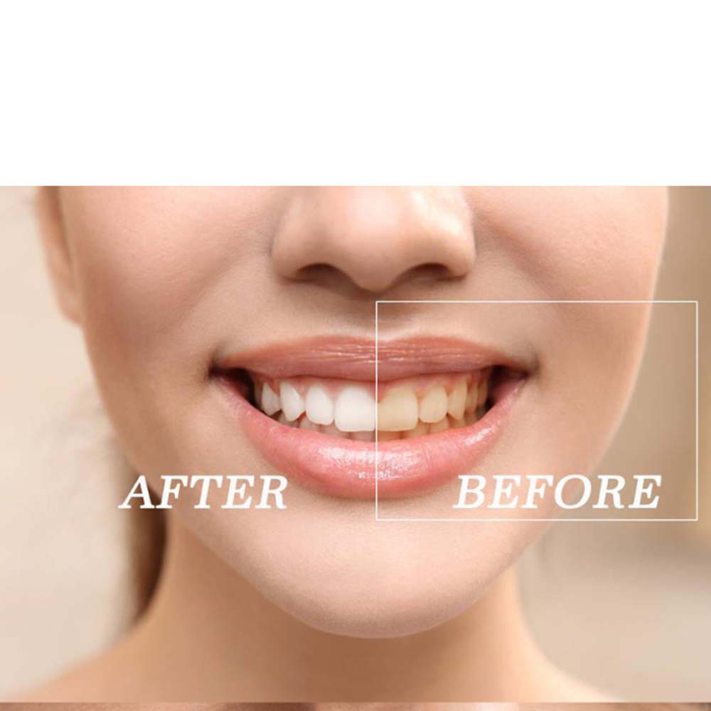 Top Quality Peroxide Teeth Whi - Teeth Whitening With Peroxide recension och pris
