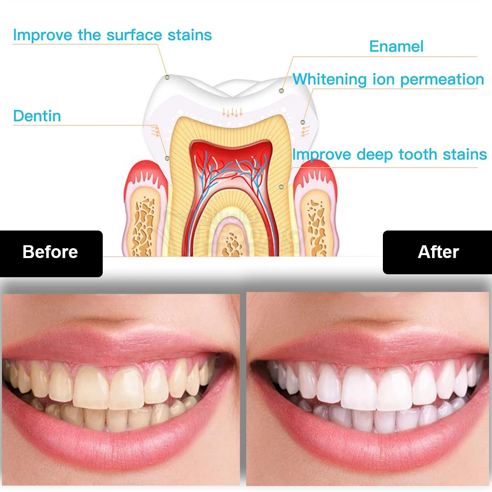 Dental Teeth Whitening Kit Min - Teeth Whitening Results recension och pris